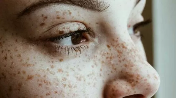  کک و مک روی صورت چیست ؟ درمانش چیست ؟