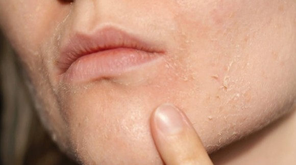 روتین پوستی مناسب پوست های خشک و خیلی خشک